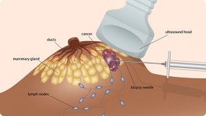 بیوپسی پستان