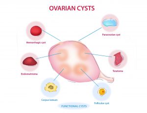 انواع کیست تخمدان