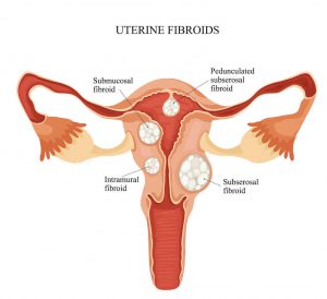 فیبروم رحم